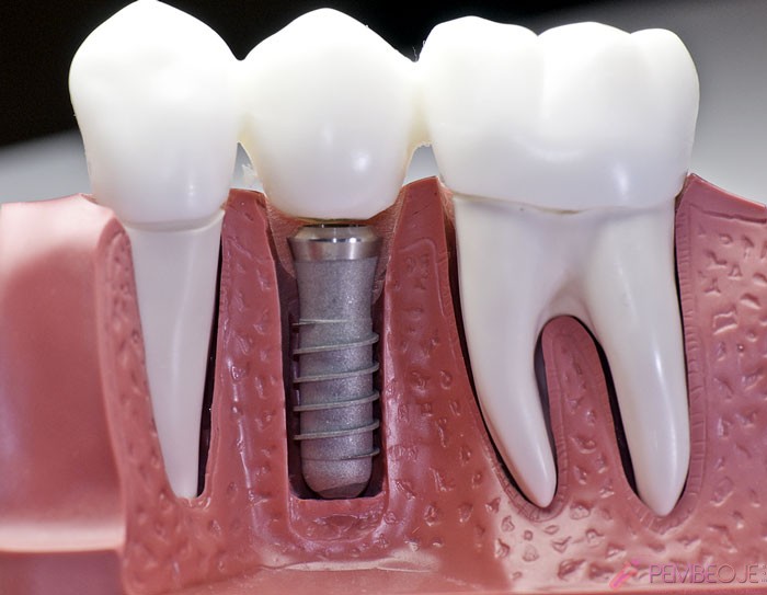 diş implant nasıl yapılır