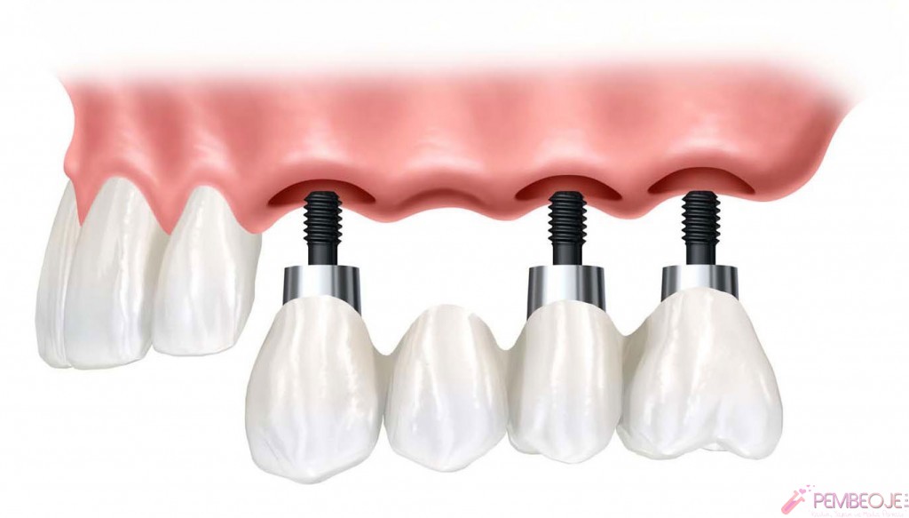 implant fiyatları