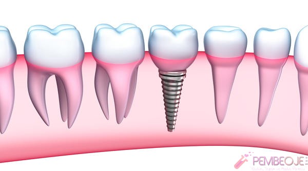 implant nedir