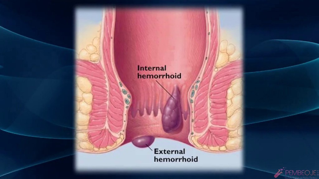 iç ve dış hemoroid