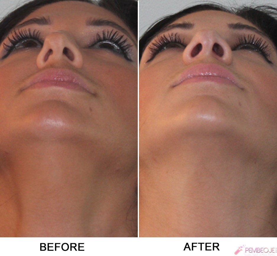Septum Deviasyonu Nedir Septum Deviasyonu Nedir
