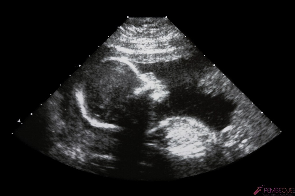 Gebeliğin 5.Ayı Ultrason Görüntüsü