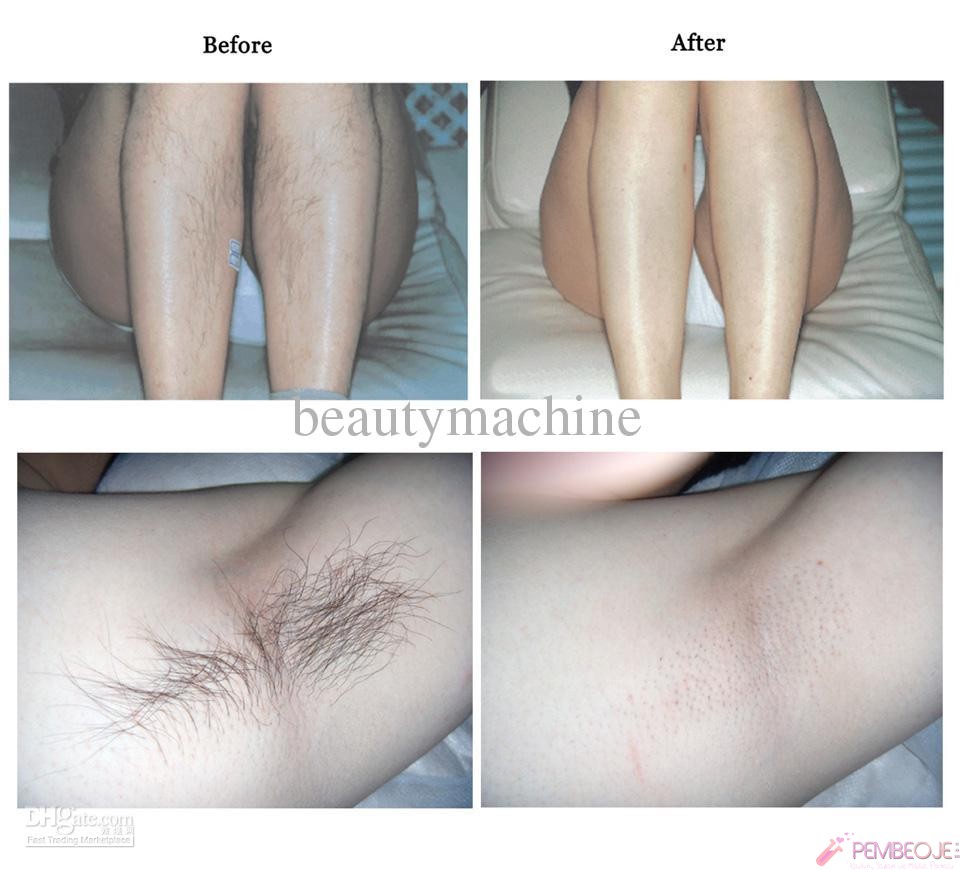 Genital Bölgeye Ağda Nasıl Yapılır Genital Bölgeye Ağda Nasıl Yapılır