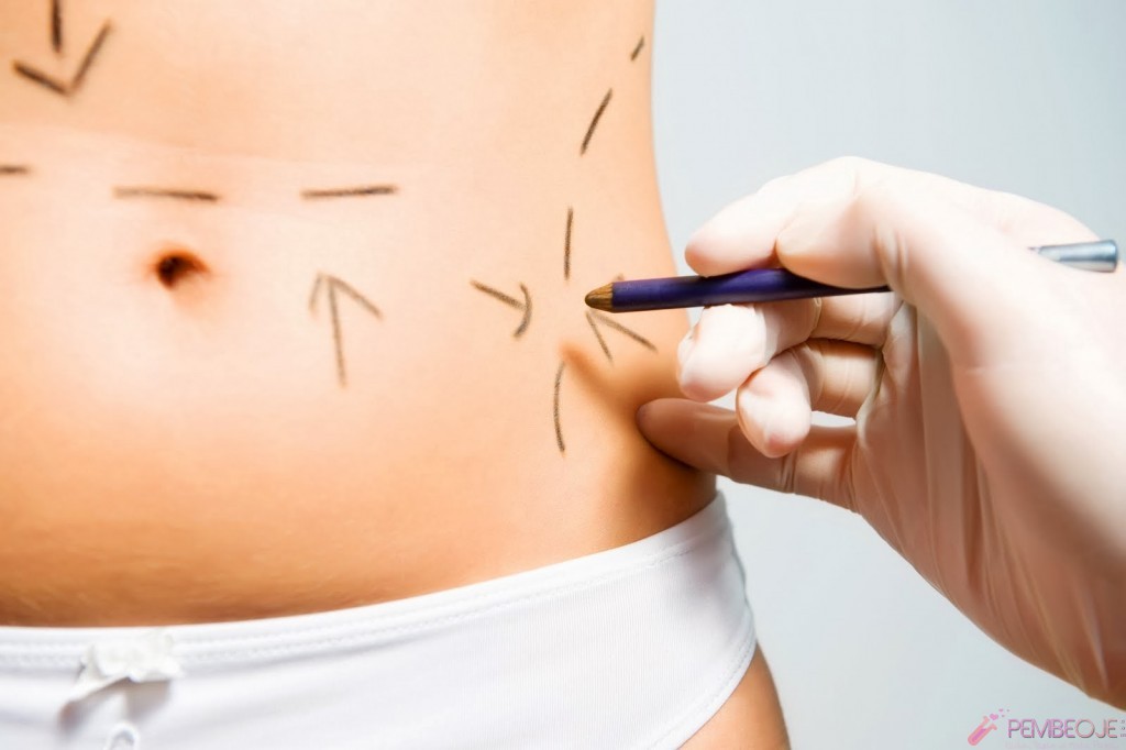 Liposuction Nasıl Yapılır