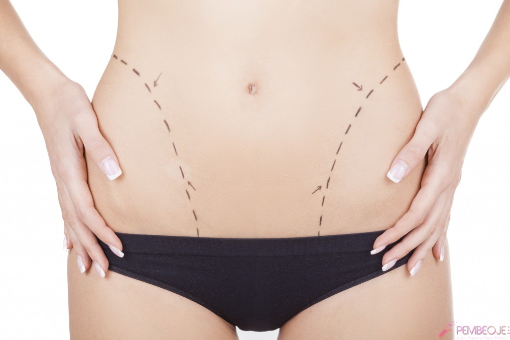 Liposuction Sonrası