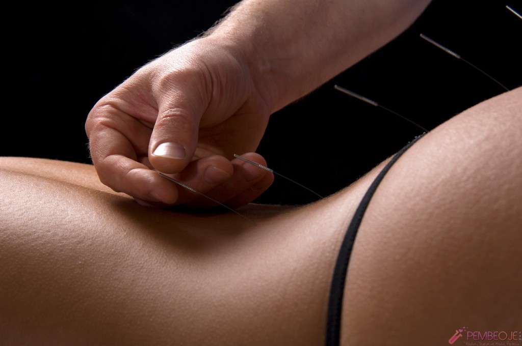 Akupunktur Bölgesel Zayıflama