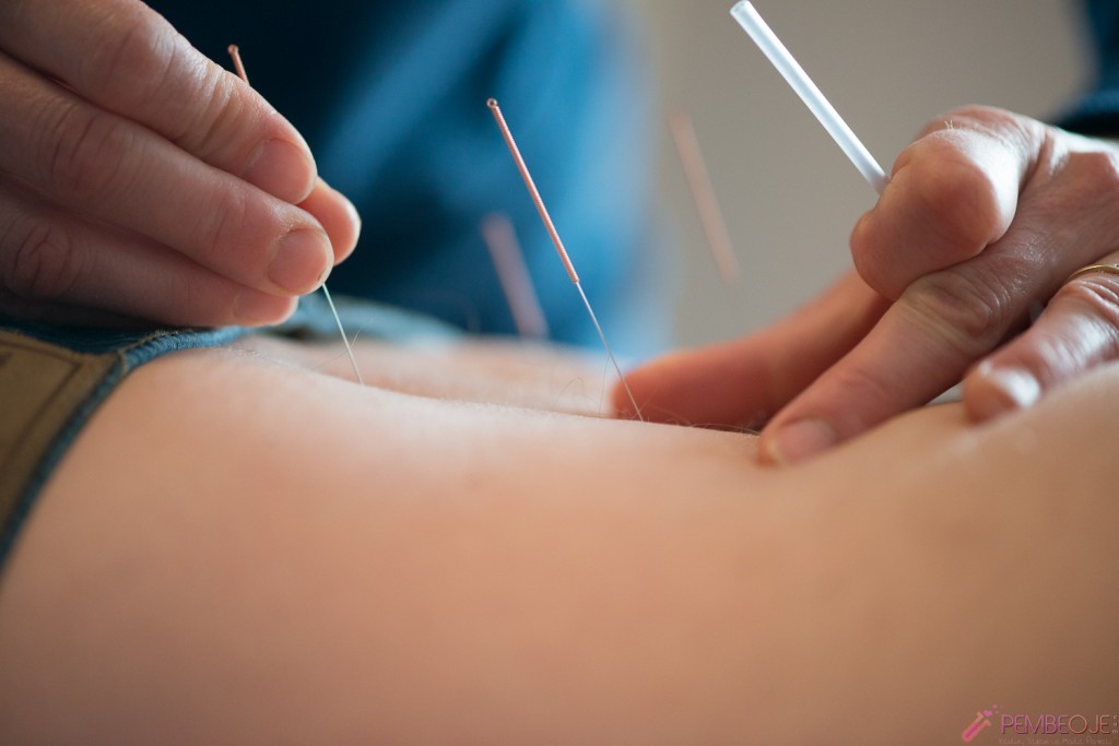 Akupunktur Bölgesel Zayıflama Öncesi ve Sonrası