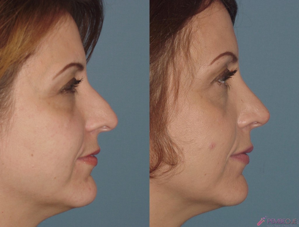 Burun Dolgusunda Hangi Dolgu Maddeleri Kullanılır?