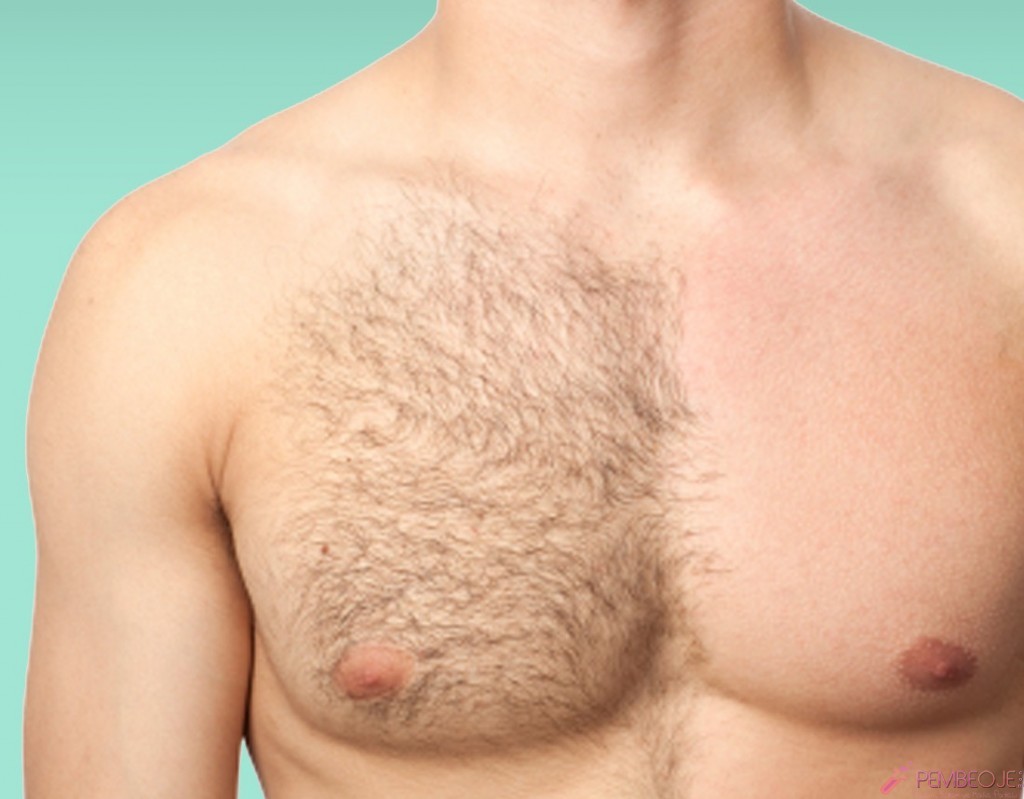 Erkek göğüs bölgesi epilasyonu