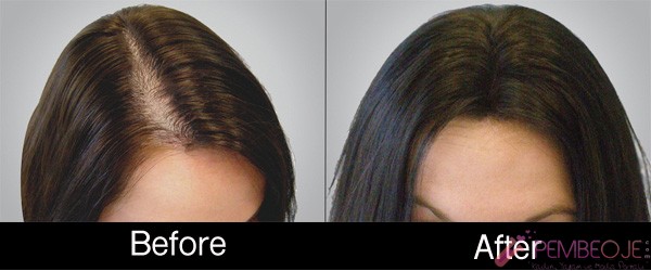 PRP ile Saç Tedavisi Öncesi ve Sonrası
