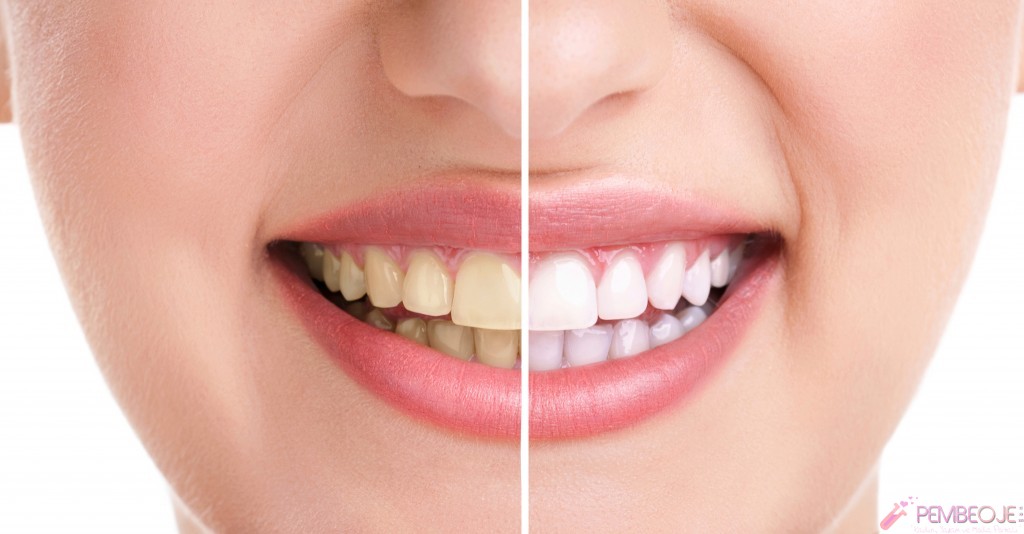 Diş Beyazlatma Öncesi ve Sonrası