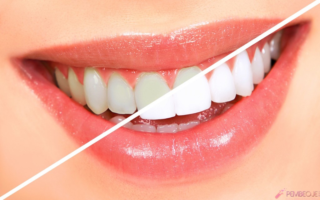 Evde diş beyazlatma yöntemleri