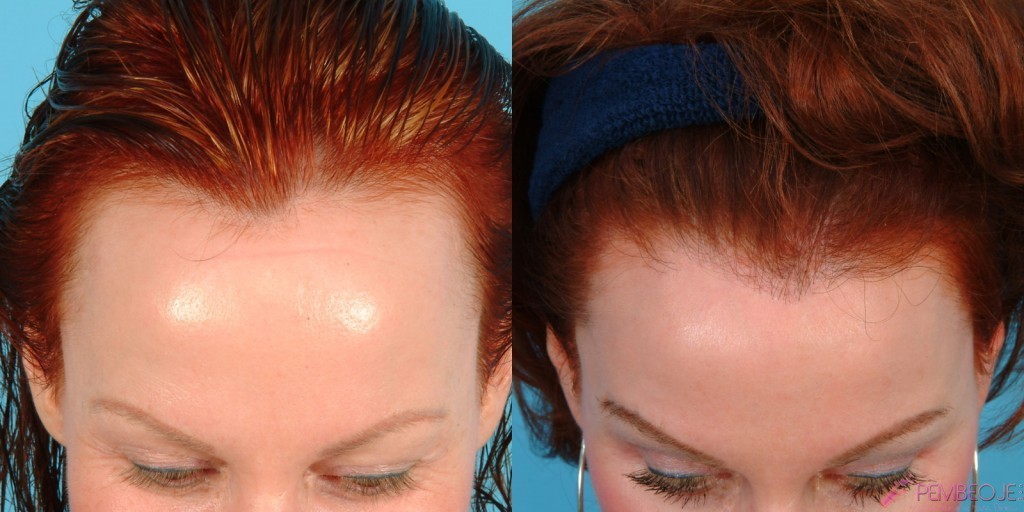 PRP Saç Tedavisi Öncesi ve Sonrası