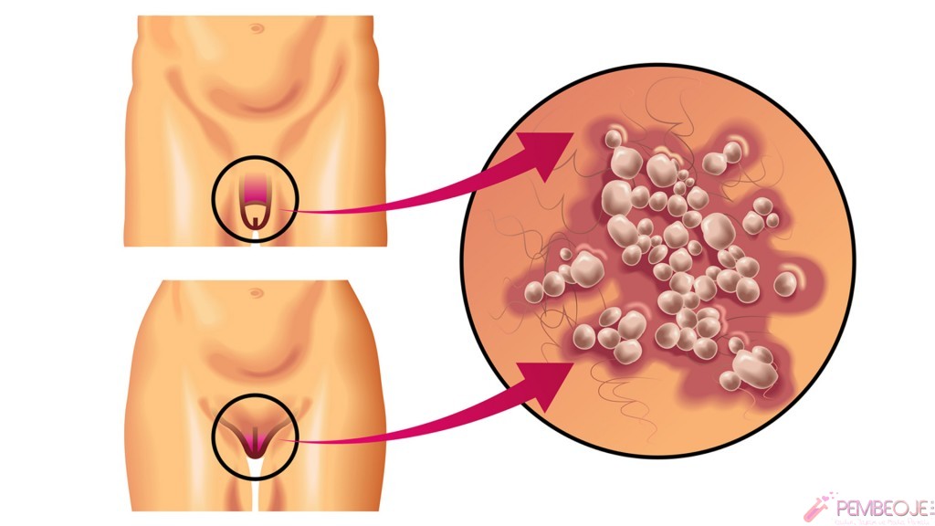 genital bölgemin iç dudak kenarında sivilce