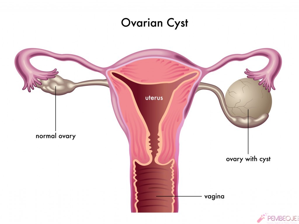 Yumurtalık Kistleri