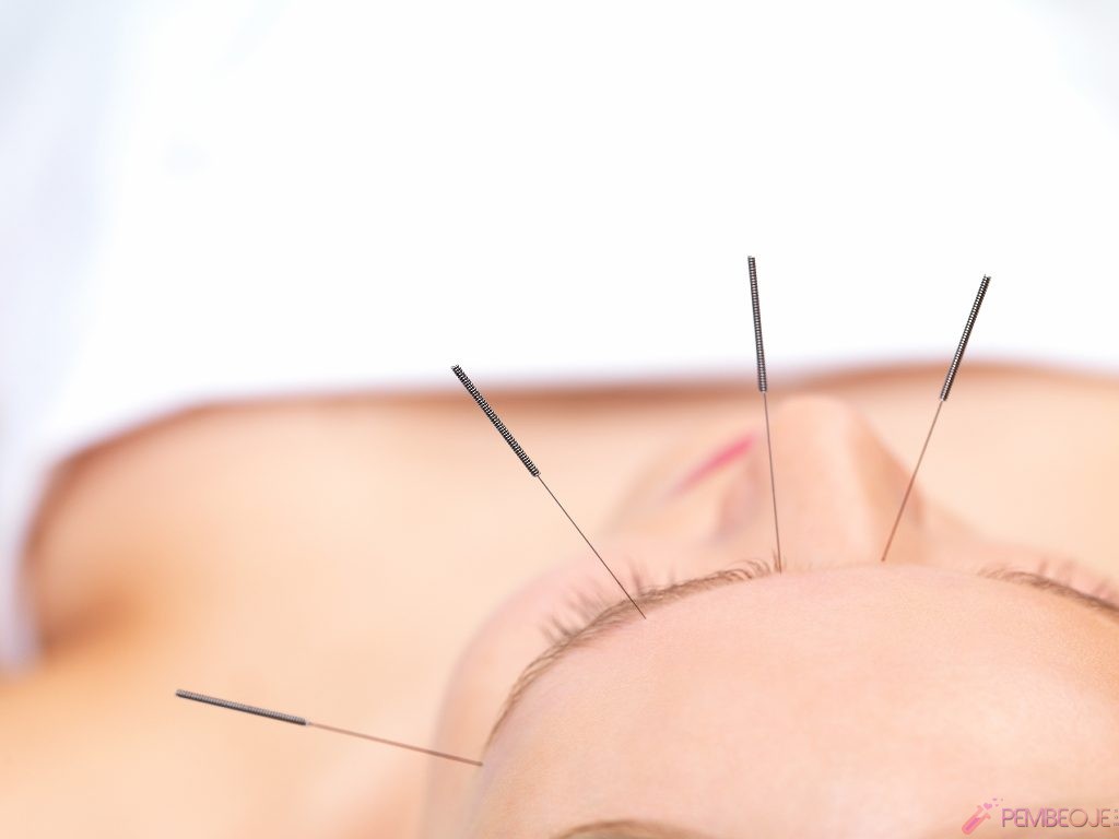 Akupunktur Yöntemi İle Zayıflama
