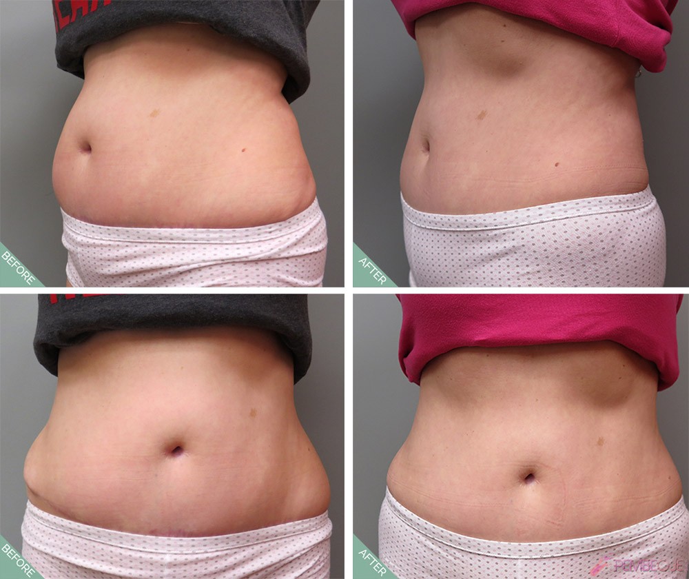 Ultrashape, nedir, bölgesel zayıflama, zararları, merkezleri, fiyatları Ultrashape, nedir, bölgesel zayıflama, zararları, merkezleri, fiyatları