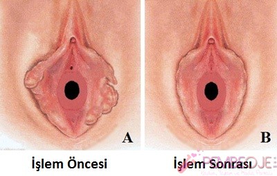 Vajina Daraltma Öncesi ve Sonrası