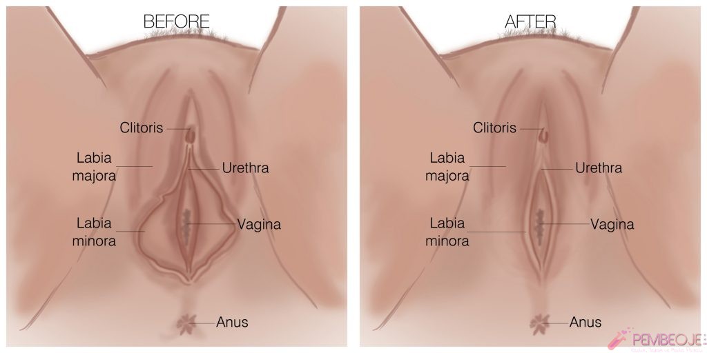 Vajina iç ve Dış Dudak Sarkması Estetiği Öncesi ve Sonrası