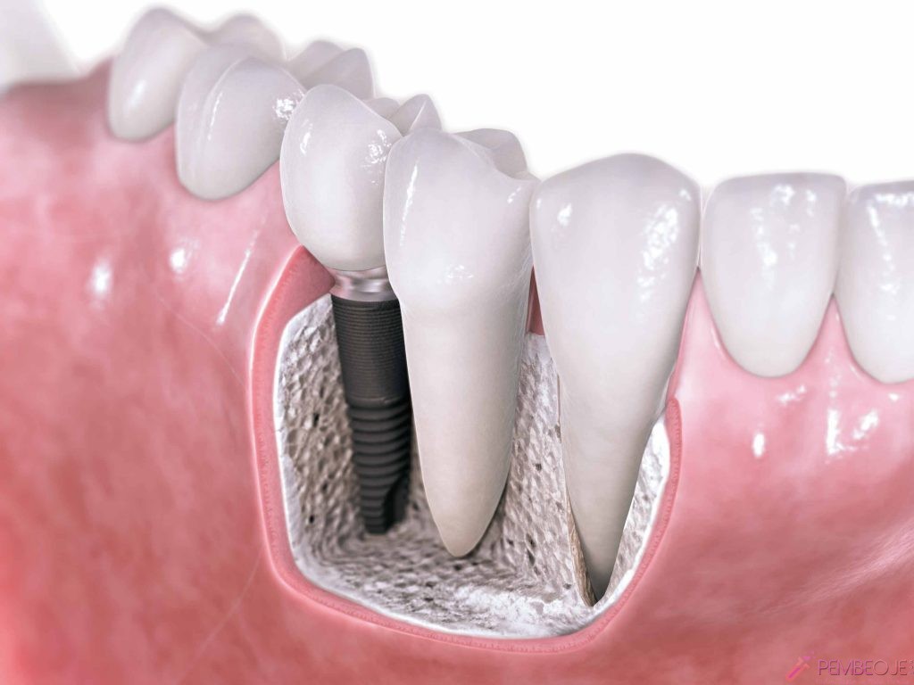 Zirkonyum Diş Kaplama Nasıl Yapılır 