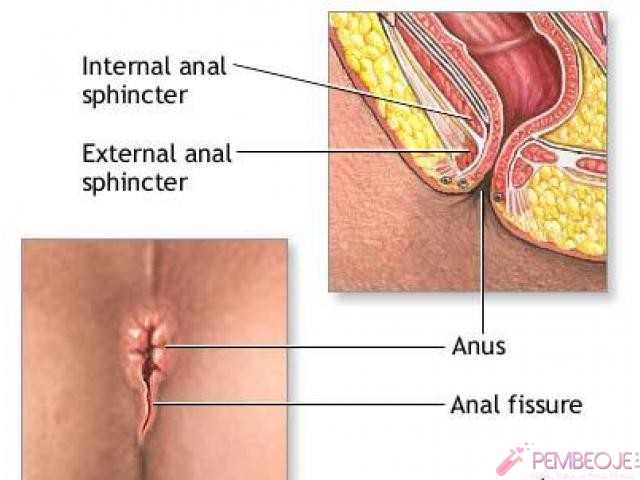 Makatta Çatlak (Anal Fissür) İçin Ameliyatsız Tedavi