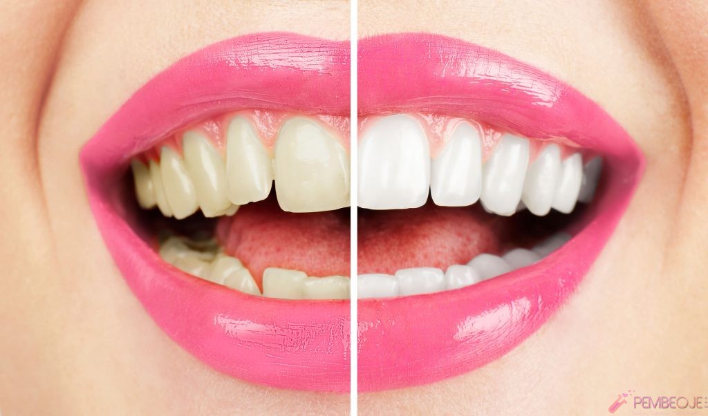 Evde Uygulayabileceğiniz Doğal Diş Beyazlatma Yöntemleri